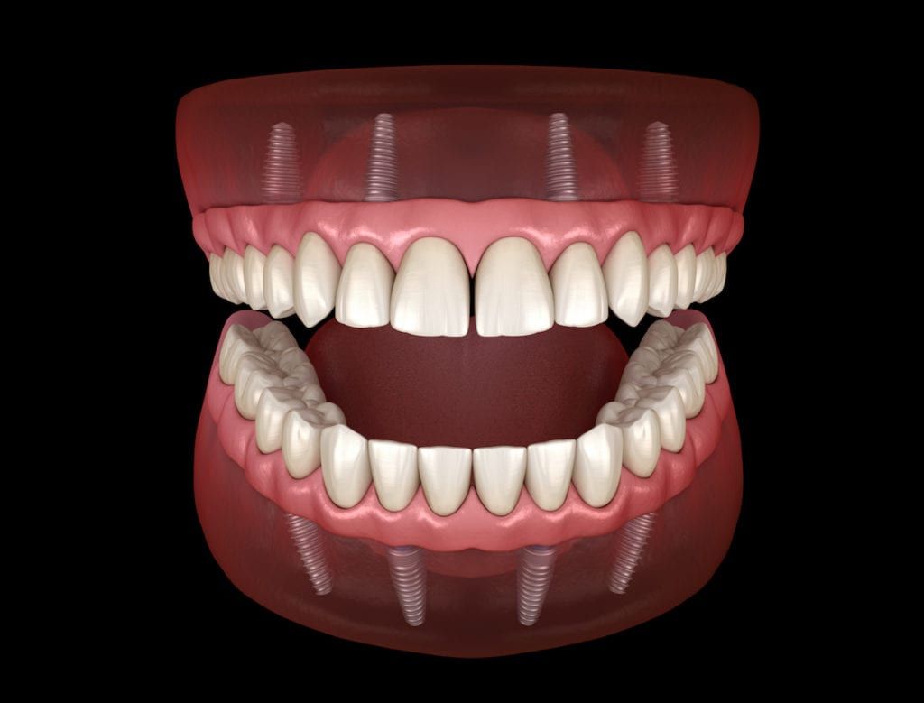 Graphic of how all-in-four dentures look when placed in the mouth
