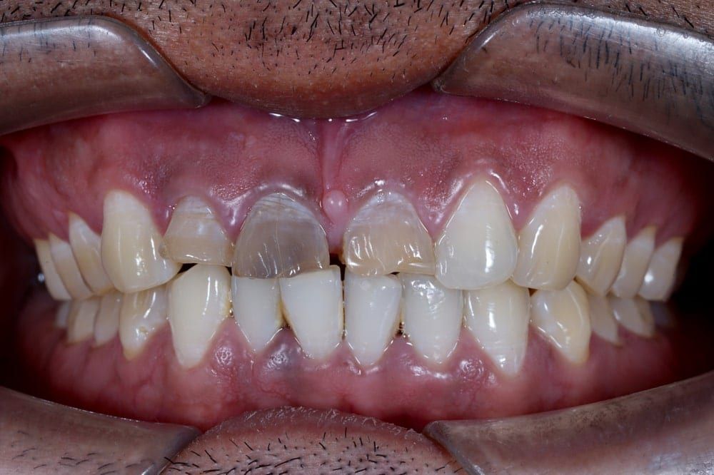 discolored tooth