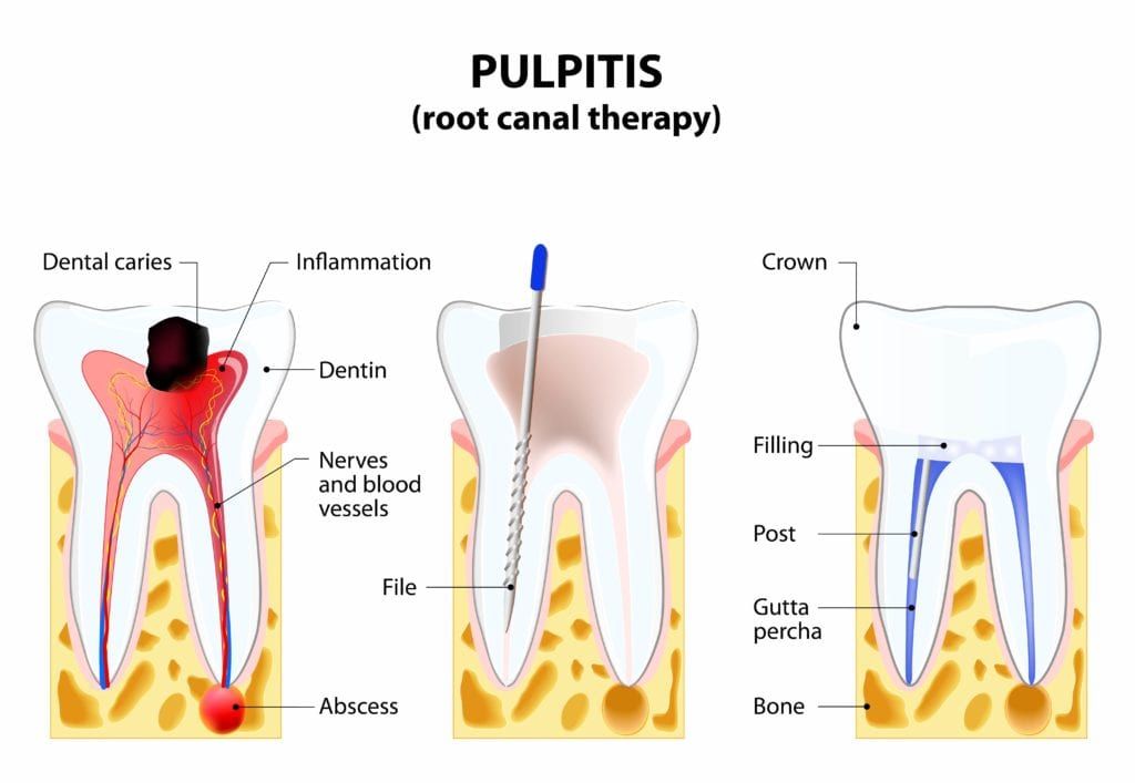 Steps of root canal
