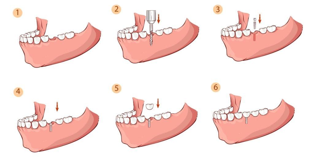 stages of dental implant placement