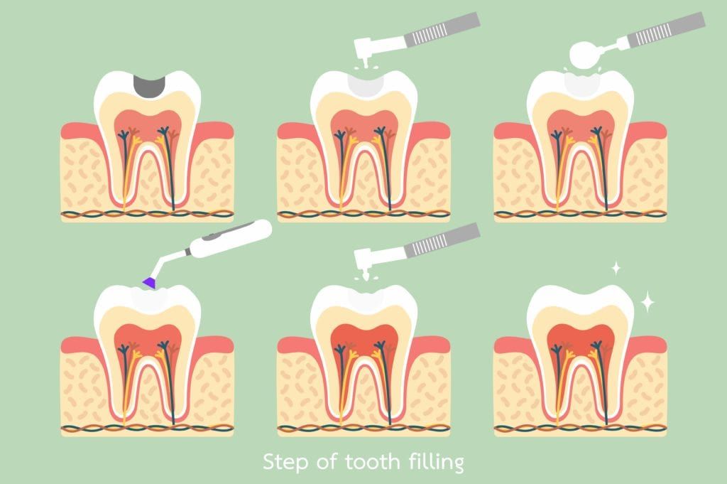 steps of tooth filling