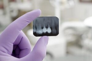 Why Dental X-Rays Are So Important
