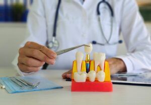 The Advantages of Dental Implants for Tooth Replacement